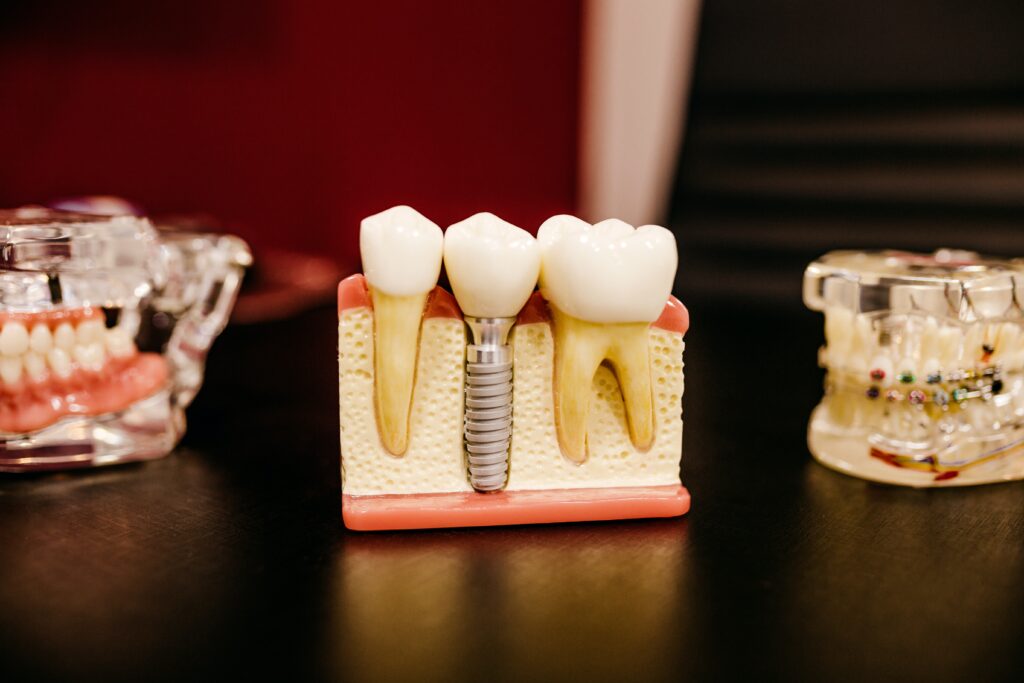 Zaawansowane implanty zębowe oferowane przez Syrenka Dental na Ursynowie, Warszawa - Twoja droga do idealnego uśmiechu.