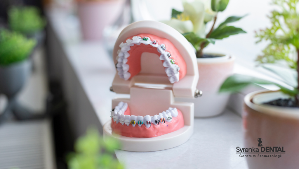 Szczegółowy model zębów wyposażonych w nowoczesny samoligaturujący aparat ortodontyczny, wystawiony w jasnym i przyjaznym otoczeniu gabinetu ortodonty na Ursynowie.