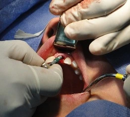 Profesjonalne implanty zębowe na Ursynowie w Syrenka Dental - połączenie nowoczesnej technologii i ekspertyzy dla Twojego uśmiechu.